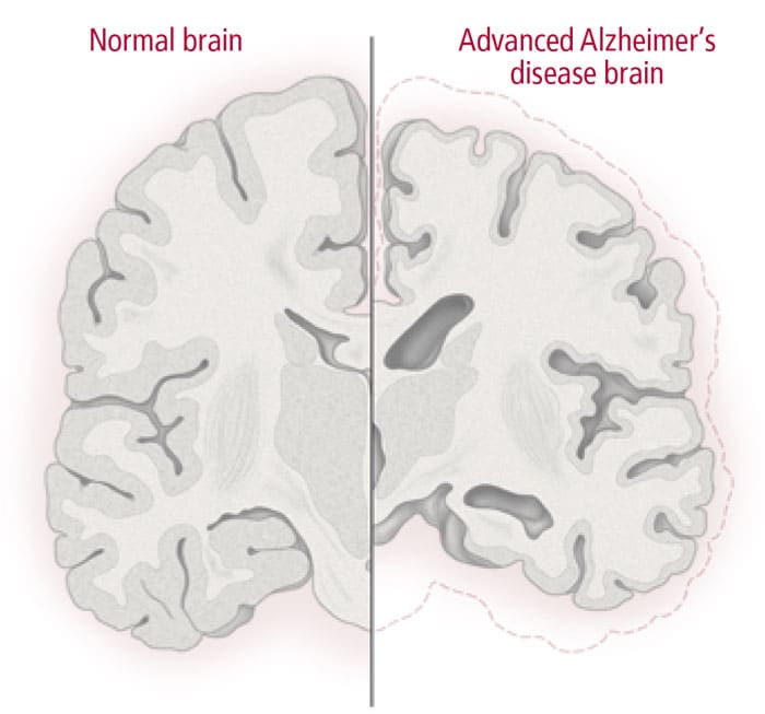 Normal vs Alzheimer's brain